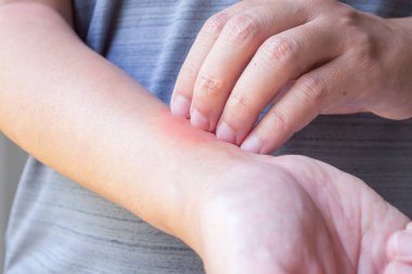 Genç Asyalı adam kaşınıyor ve kolunda kaşıntı var alerjik kaşıntı yüzünden kuru cilt egzama dermatit böceği ısırıkları.
