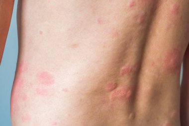 Genç Asyalı adam kaşınıyor ve sırtını kaşındırıyor alerjik kaşınıyor kuru cilt egzama dermatit böceği ısırıkları