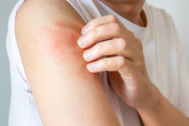 Genç Asyalı adam kaşınıyor ve kolunda kaşıntı var alerjik kaşıntı yüzünden kuru cilt egzama dermatit böceği ısırıkları.