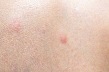 Deri alerjisi kızarıklığı dermatit dokusu kapanıyor.