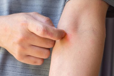Genç Asyalı adam kaşınıyor ve kolunda kaşıntı var alerjik kaşıntı yüzünden kuru cilt egzama dermatit böceği ısırıkları.