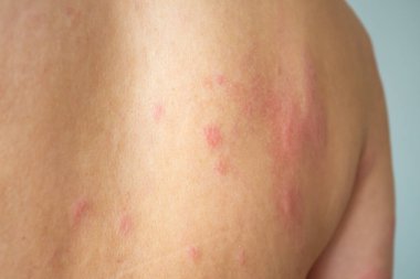 Genç Asyalı adam kaşınıyor ve sırtını kaşındırıyor alerjik kaşınıyor kuru cilt egzama dermatit böceği ısırıkları