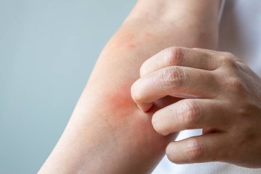 Genç Asyalı adam kaşınıyor ve kolunda kaşıntı var alerjik kaşıntı yüzünden kuru cilt egzama dermatit böceği ısırıkları.