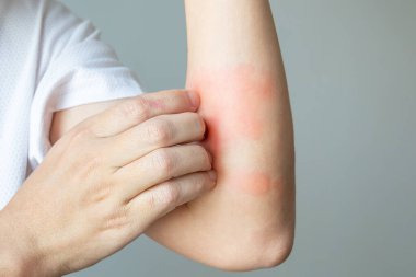 Genç Asyalı adam kaşınıyor ve kolunda kaşıntı var alerjik kaşıntı yüzünden kuru cilt egzama dermatit böceği ısırıkları.