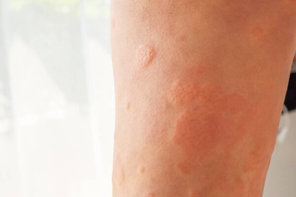 У молодого азиата аллергическая кожная сыпь на ногах от зудящих сухих укусов кожных насекомых.