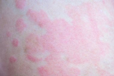 Deri alerjisi kızarıklığı dermatit dokusu kapanıyor.