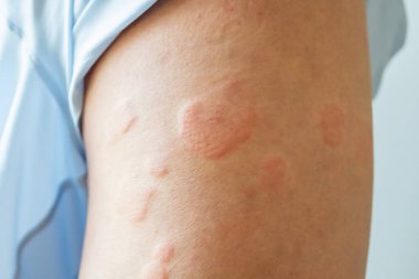 Genç Asyalı adamın bacaklarında kaşındıran kuru deri egzama derisi ısırığından kaynaklanan alerjik deri döküntüsü var.