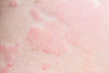Deri alerjisi kızarıklığı dermatit dokusu kapanıyor.
