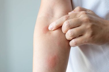 Genç Asyalı adam kaşınıyor ve kolunda kaşıntı var alerjik kaşıntı yüzünden kuru cilt egzama dermatit böceği ısırıkları.