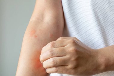 Genç Asyalı adam kaşınıyor ve kolunda kaşıntı var alerjik kaşıntı yüzünden kuru cilt egzama dermatit böceği ısırıkları.