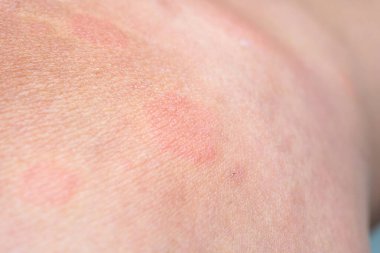 Genç Asyalı adamın bacaklarında kaşındıran kuru deri egzama derisi ısırığından kaynaklanan alerjik deri döküntüsü var.