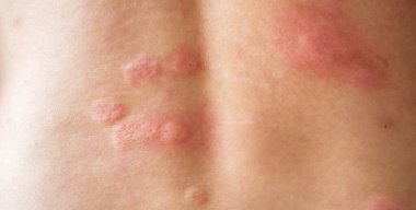 Genç Asyalı adam kaşınıyor ve sırtını kaşındırıyor alerjik kaşınıyor kuru cilt egzama dermatit böceği ısırıkları