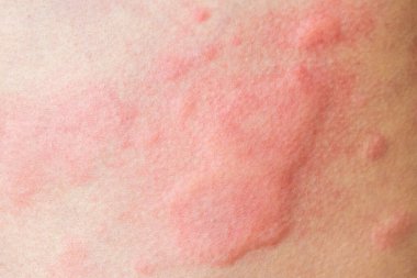 Cilt alerjisi isilik dermatit dokusu, arka planı kapatın.