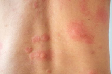 Genç Asyalı adam kaşınıyor ve sırtını kaşındırıyor alerjik kaşınıyor kuru cilt egzama dermatit böceği ısırıkları