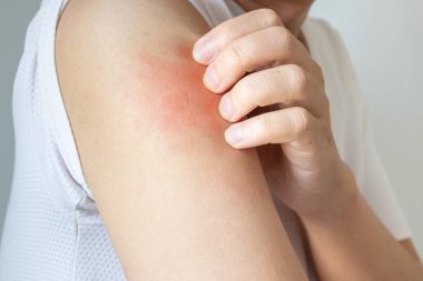 Genç Asyalı adam kaşınıyor ve kolunda kaşıntı var alerjik kaşıntı yüzünden kuru cilt egzama dermatit böceği ısırıkları.