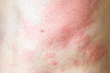 Genç Asyalı adam kaşınıyor ve sırtını kaşındırıyor alerjik kaşınıyor kuru cilt egzama dermatit böceği ısırıkları