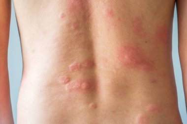 Genç Asyalı adam kaşınıyor ve sırtını kaşındırıyor alerjik kaşınıyor kuru cilt egzama dermatit böceği ısırıkları