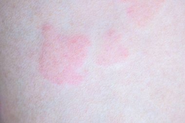Deri alerjisi kızarıklığı dermatit dokusu kapanıyor.