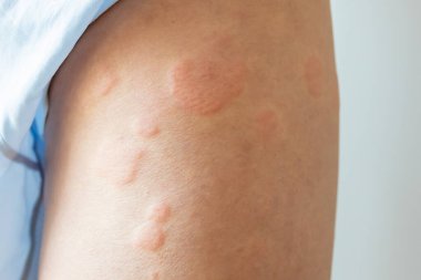 Genç Asyalı adamın bacaklarında kaşındıran kuru deri egzama derisi ısırığından kaynaklanan alerjik deri döküntüsü var.