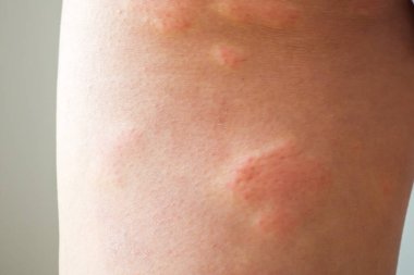 Genç Asyalı adamın bacaklarında kaşındıran kuru deri egzama derisi ısırığından kaynaklanan alerjik deri döküntüsü var.