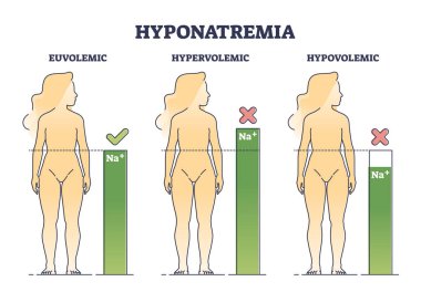 Düşük sodyum tuz seviyesi şeması olan hiponatremi vücut durumu. Na ile normal vektör illüstrasyonunun altında veya üstünde eğitimsel tıbbi hastalık karşılaştırması. Övolemik ve hipovolemik.