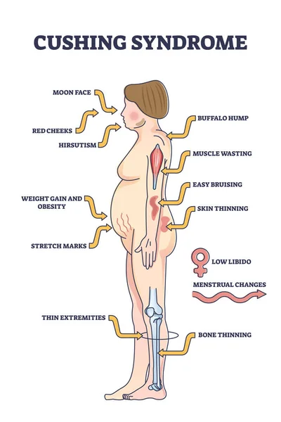 Yüksek Kortizol Düzeyi Ana Hat Diyagramındaki Cushing Sendromu Semptomları Hormonal — Stok Vektör