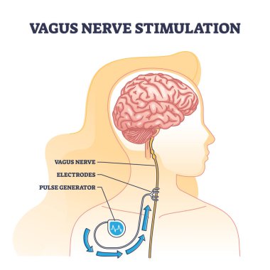 Beyin şeması için tıbbi cihaz implantı olarak Vagus sinir uyarımı. Epilepsi ya da depresyon tedavisi için elektrot ya da elektrik sinyal jeneratörü ile etiketlenmiş şema