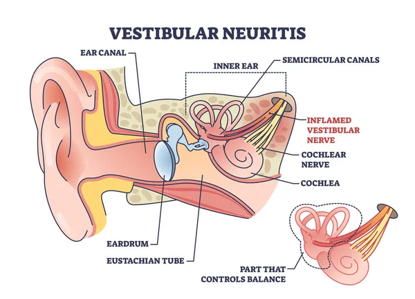 Neuritis Vestibular Como Enfermedad Inflamación Del Nervio Del Oído Interno — Archivo Imágenes Vectoriales