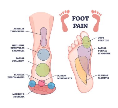 Foot pain causes from zones diagnosis and painful spots areas outline diagram. Labeled educational scheme with medical illness, disease or trauma diagnostics vector illustration. Tendonitis, bursitis clipart