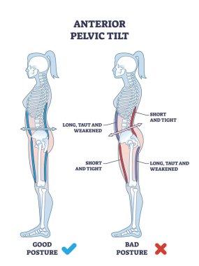 Anterior pelvik eğim veya pelvis anormal duruş şeması olarak APT. Bel omurgasının artan lordozu ve karın vektörü çiziminin çıkıntısından kaynaklanan sendrom ile etiketlenmiş eğitim şeması.