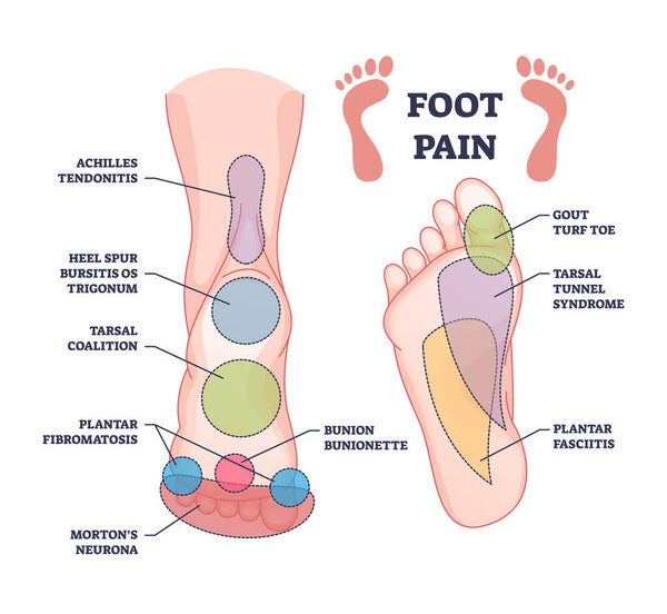 Foot pain causes from zones diagnosis and painful spots areas outline diagram. Labeled educational scheme with medical illness, disease or trauma diagnostics vector illustration. Tendonitis, bursitis