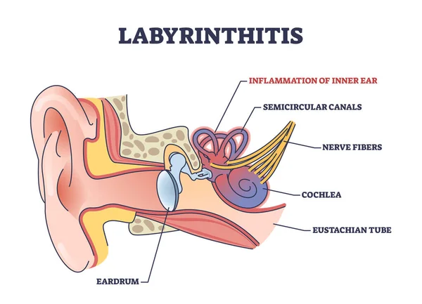 Labyrinthite Comme Infection Oreille Interne Schéma Contour Inflammation Médicale Schéma — Image vectorielle