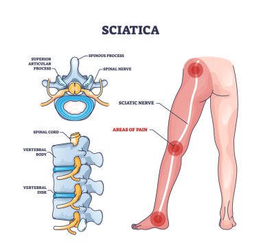 Ağrının siyatik bölgelerinde bacak çizgisi diyagramında anatomik konum var. Tıbbi sorun, hastalık ya da omurilikten kaynaklanan hastalık ya da illüstrasyon belirtileriyle etiketlenmiş eğitim şeması.