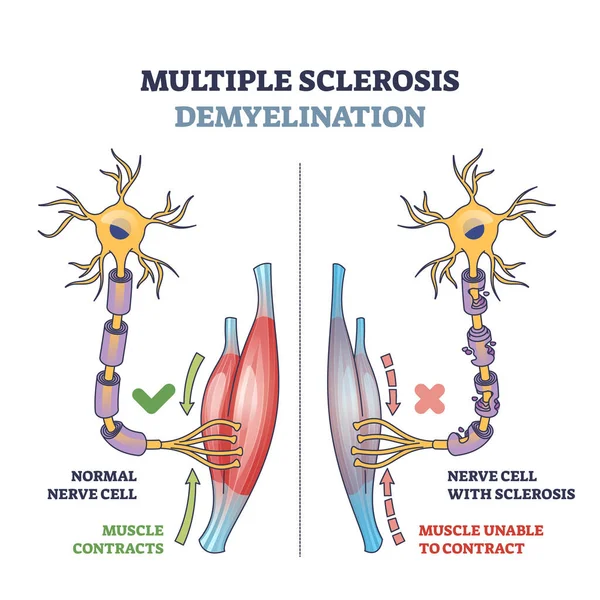 Multiple Sclerosis Demyelination Compared Medical Healthy Nerves Outline Diagram Labeled — Stock Vector