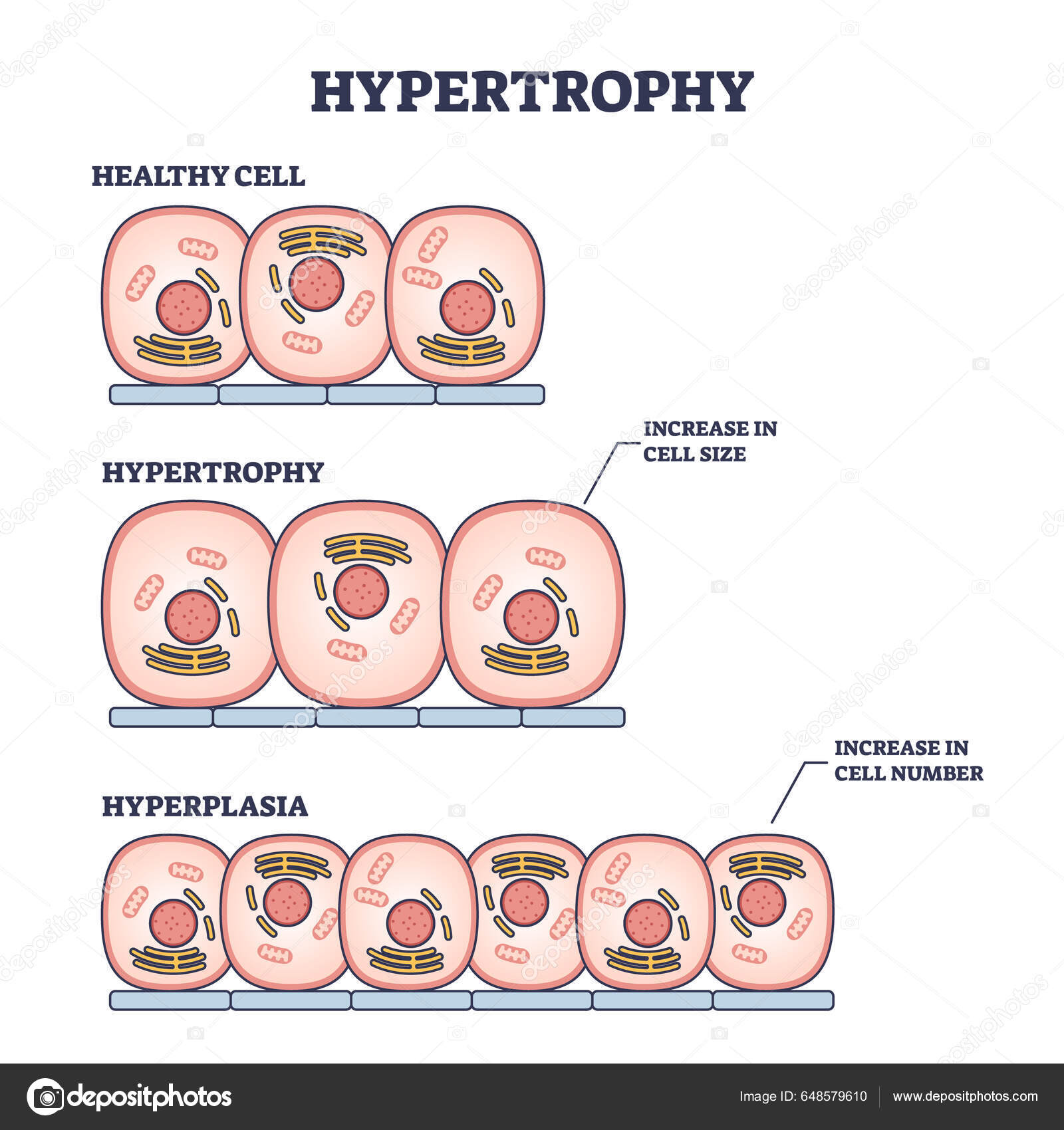 Hypertrophy Hyperplasia Healthy Muscular Cells Comparison Outline
