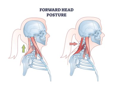 Sağlıklı boyun konumu şeması ile karşılaştırıldığında baş öne doğru duruşu. Eğitimsel şema kaplumbağa boynu durumu ve kas sistemi vektör çizimi. Anatomik omurga problemi açıklaması.