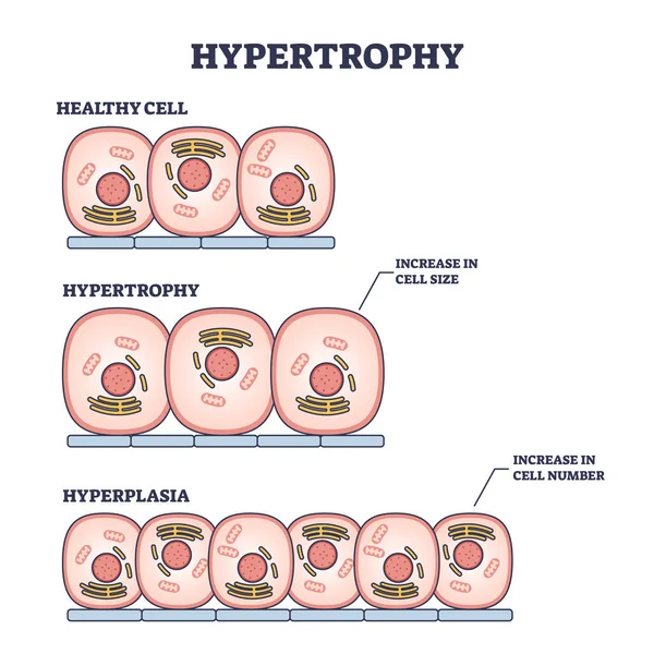 Hipertrofia Hiperplasia Comparação Células Musculares Saudáveis Esboço Diagrama Esquema Educacional — Vetor de Stock