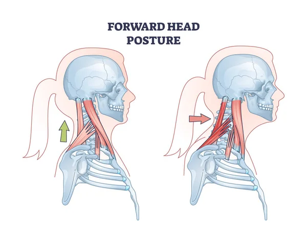 前头姿势与健康颈部姿势对比示意图 具有龟颈状况和肌肉系统载体图解的教育方案 解剖脊柱问题的解释 — 图库矢量图片