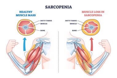 Sarcopenia as muscle mass loss and fatty tissue growth outline diagram. Labeled educational medical scheme with aging caused weakness and muscular pathology vector illustration. Obesity health issue. clipart