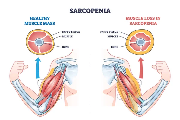 Sarcopénie Comme Perte Masse Musculaire Schéma Croissance Tissu Adipeux Labellisé — Image vectorielle