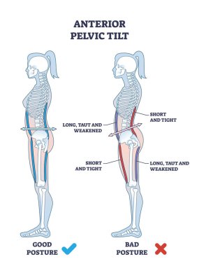 Anterior pelvik eğim veya pelvis anormal duruş şeması olarak APT. Bel omurgasının artan lordozu ve karın vektörü çiziminin çıkıntısından kaynaklanan sendrom ile etiketlenmiş eğitim şeması.