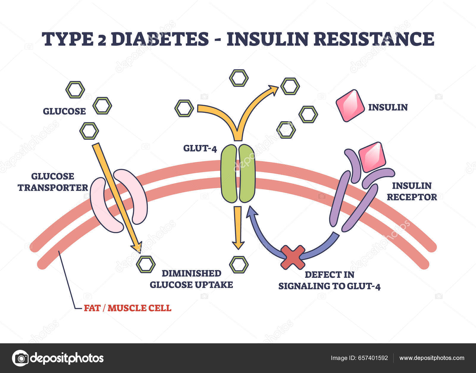 Type Diabetes Insulin Resistance Anatomical Explanation Outline Diagram ...