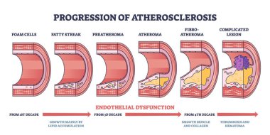 Aterosklerozun ilerlemesi ve tromboz oluşum şeması. Endothelial disfonksiyon geliştirme ile etiketlenmiş eğitim tıbbi aşamaları damarda karmaşık lezyon vektör çizimi.