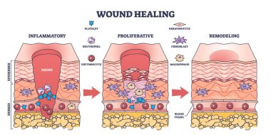 Yaraların iyileşme süreci ve anatomik vücut hasarı düzeltme şeması. Estetik deri iltihabı, çoğalma ya da yeniden biçimlendirme, tıbbi üst deri iltihabı ile etiketlenmiş eğitim şeması, vektör illüstrasyonları