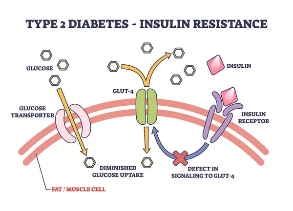 タイプ2糖尿病とインスリン抵抗性解剖学的説明アウトライン図 インスリン受容体 Glut欠陥と減少取り込みベクトルイラストとラベル医療科学表現 — ストックベクタ