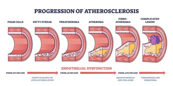 Aterosklerozun Ilerlemesi Tromboz Oluşum Şeması Endothelial Disfonksiyon Geliştirme Ile Etiketlenmiş — Stok Vektör