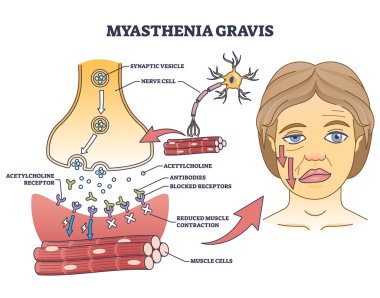 Otoimmün olarak miyasthenia gravis, nöromüsküler hastalık şeması. Çizgili kaslı, eğitimsel tıbbi şema, vektör illüstrasyonundaki zayıflık belirtileri. Anatomik hastalık açıklaması.