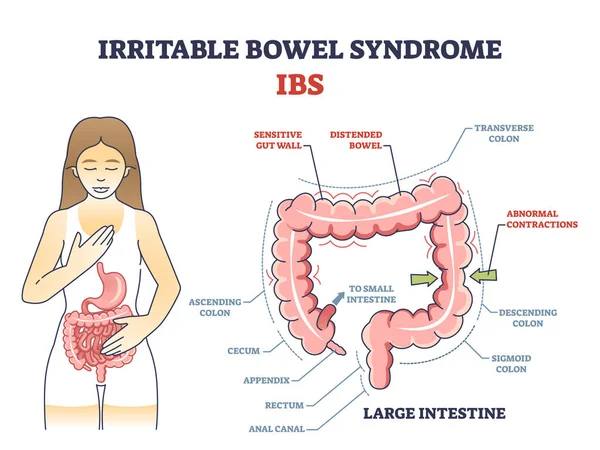 Síndrome Del Intestino Irritable Sii Como Problema Salud Digestiva Diagrama — Archivo Imágenes Vectoriales