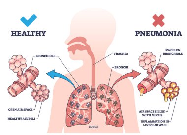 Pneumonia illness medical comparison with healthy lungs outline diagram. Respiratory system problem with bronchi wall inflammation and air filled with mucus vector illustration. Bacterial infection. clipart