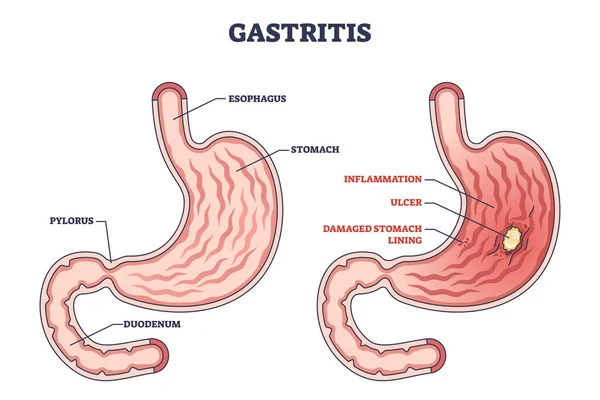 Gastritis Como Revestimiento Estomacal Inflamación Enfermedad Enfermedad Esquema Diagrama Etiquetado — Archivo Imágenes Vectoriales